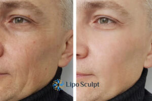 How to Fight Aging Symptoms 3 Fight Aging Symptoms Wheathampstead With HIFU and Morpheus8 Today!