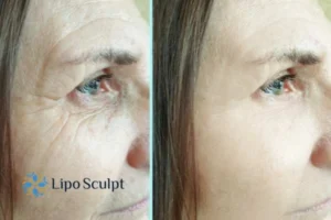 How to Fight Aging Symptoms 2 Do you want to Fight Aging Symptoms Wheathampstead? Contact Lipo Sculpt today!