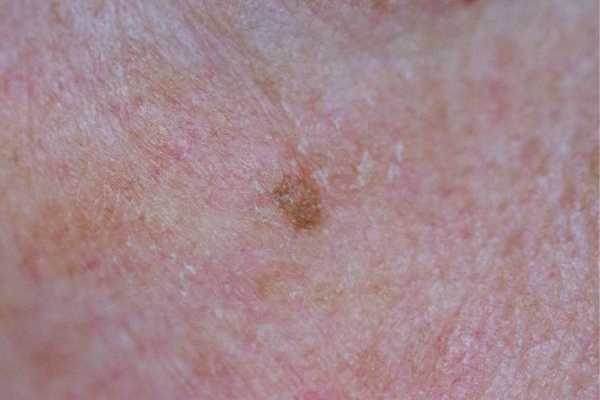 CryoPen for Seborrhoeic Keratosis: What to Know Before Treatment 4 CryoPen for Seborrhoeic Keratosis: What to Know Before Treatment