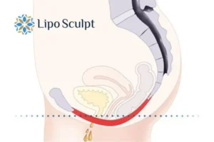 Pelvic Floor Chair Therapy 1 Pelvic Floor Chair Therapy Wheathampstead to treat incontinence.
