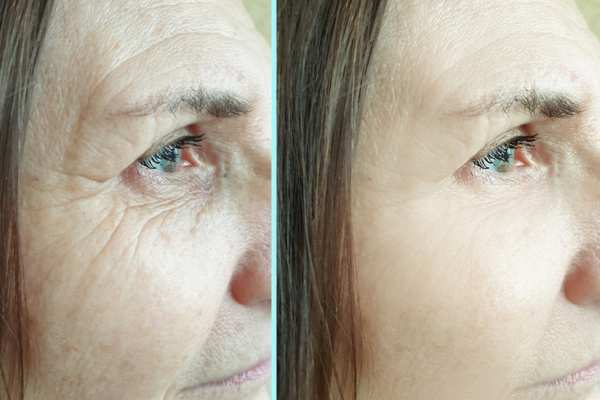 Why Do People Choose HIFU for a Non-Surgical Facelift? 4 How long can HIFU results last Wheathampstead?