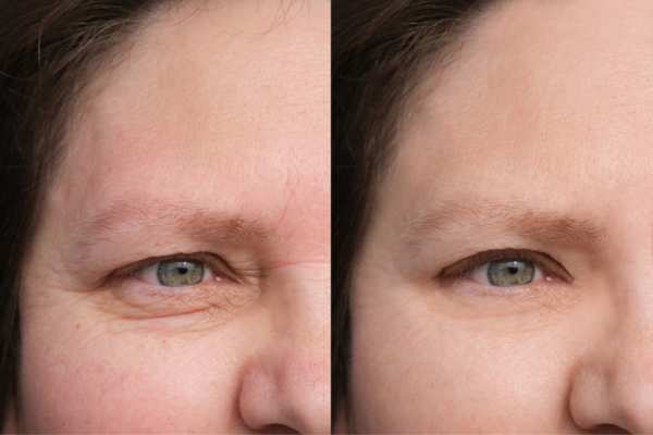HIFU vs Botulinum Toxin: Understanding the Differences 4 How long do HIFU results last Wheathampstead?