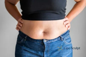 Bidding Farewell to Muffin Tops with Aqualyx Fat Injections 2 Do you wish you could reduce your muffin top Wheathampstead With Aqualy fat dissolving injections you can!