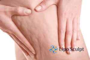 CoolSculpting for Legs: The Innovative Approach to Redefining Your Legs 5 Start your journey today book your coolsculpting treatment Wheathampstead online today!