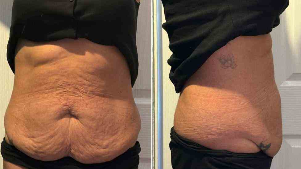 Lost the Weight but Not the Loose Skin? What You Should Know 1 Is It Definitely Loose Skin Wheathampstead?